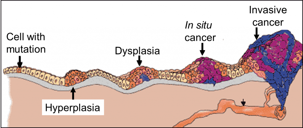 تطور السرطان