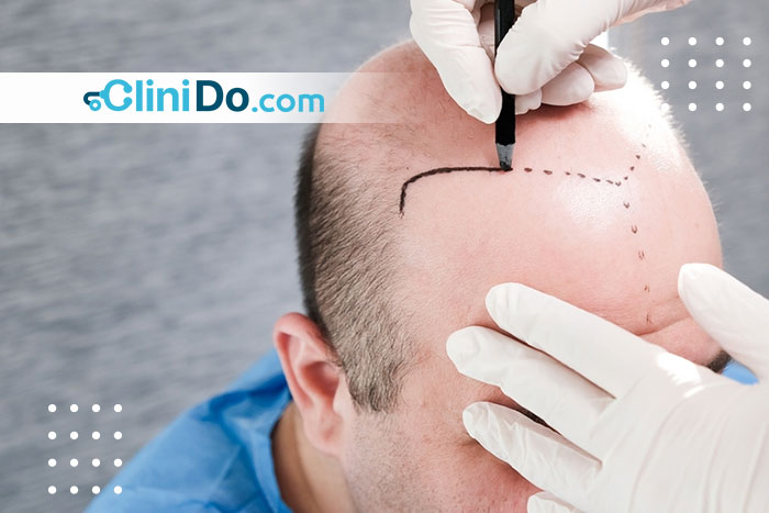 زراعة الشعر في مصر