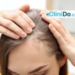 علاج الثعلبة